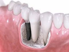 Vista Interna de Implante. - Clínica Dental Jorge del Corral