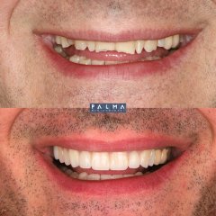 Carillas de Disilicato - Clínica Palma Medicodental