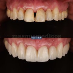 Carillas de Composite - Clínica Palma Medicodental