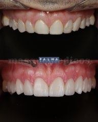 Carillas de Disilicato - Clínica Palma Medicodental