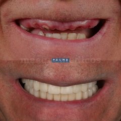 Rehabilitación completa con implantes de carga inmediata - Clínica Palma Medicodental