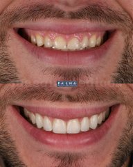 Carillas de Composite - Clínica Palma Medicodental