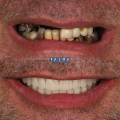 Rehabilitación completa con implantes de carga inmediata - Clínica Palma Medicodental