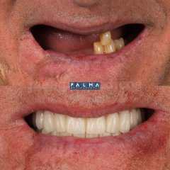 Rehabilitación completa con implantes de carga inmediata - Clínica Palma Medicodental