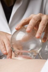 Terapia con ventosas (cupping) - David Liébanas Vallcorba