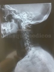 Tratamiento de la Columna Cervical - Escuela de Columna Dr.Knapp