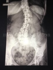 Tratamiento de Escoliosis - Escuela de Columna Dr.Knapp