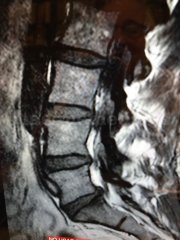 Tratamiento Hernia Discal y Protrusión Discal - Escuela de Columna Dr.Knapp