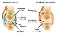 Patología articular - Metafisio