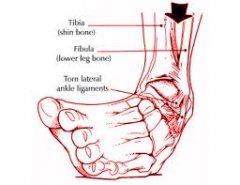 Lesiones deportivas - Metafisio