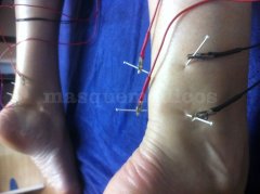 Electroacupuntura - Alberto Sacristán Rubio