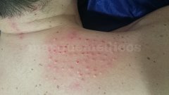 Mesoterapia en el cuello - Alberto Sacristán Rubio