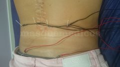 Acupuntura en paciente con dolor neuropático - SportSalud 