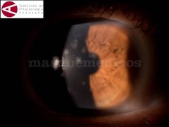 Infiltrado numulares - Instituto de Oftalmología Avanzada