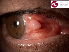 Quiste en cápsula de Tenon - Instituto de Oftalmología Avanzada