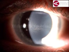 Queratopatía por amiodarona - Instituto de Oftalmología Avanzada