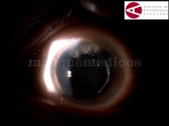 Resto de masa cristalina - Instituto de Oftalmología Avanzada