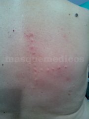 Terapia Neural - SportSalud 