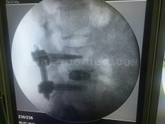 Fusión o artrodesis vertebral por endoscopia - Ricardo Casal Grau