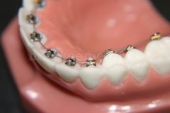 Sistema lingual de ortodoncia - Clínica Dental Rambla