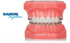 Sistema DAMON de ortodoncia - Clínica Dental Rambla