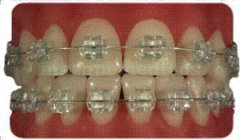 Brackets estéticos de zafiro - Clínica Dental Rambla
