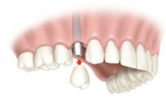 Estudio de implantes - Clínica Dental Rambla