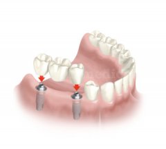 Estudio de implantes - Clínica Dental Rambla