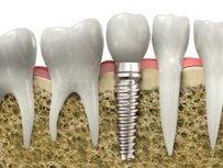 Implantes dentales - Dr. Eduardo González Cardero