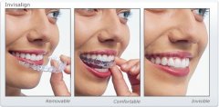 Invisalign  - Lara Navarro Manosalbas