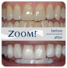 Blanqueamiento Philips Zoom! - Lara Navarro Manosalbas