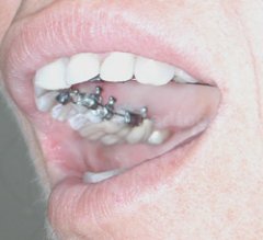 Ortodoncia Lingual INCOGNITO - Ortodoncia Sevilla