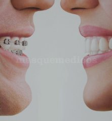 Ortodoncia Invisible INVISALIGN - Ortodoncia Sevilla