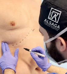 Marcaje preoperatorio. - Alberto Sánchez García