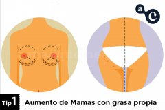 ACUALIPO- AUMENTO DE PECHO O GLÚTEOS CON GRASA PROPIA - Dr. Alexo Carballeira Braña