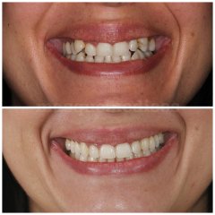 Antes y después chica joven - Clínica Dental Peydro Herrero