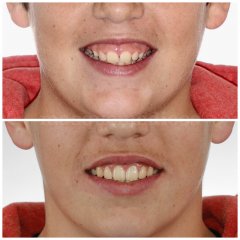 Antes y después niño  - Clínica Dental Peydro Herrero