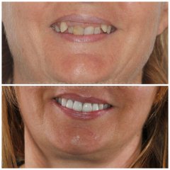 Antes y después paciente mediana edad - Clínica Dental Peydro Herrero