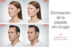 Belkyra  - Lidia Pérez Dermatólogos