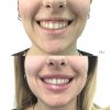 Sonrisa gingival  - Eva Garrigós Gracia