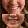 Sonrisa Gingival  - Eva Garrigós Gracia