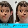 Otoplastia de orejas prominentes o separadas - Joaquim Suñol