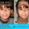 Otoplastia de orejas prominentes o separadas - Joaquim Suñol
