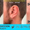 Reduccion del tamaño de las Orejas - Joaquim Suñol