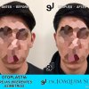 Otoplastia de orejas prominentes o separadas - Joaquim Suñol