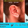 Reduccion del tamaño de las Orejas - Joaquim Suñol