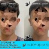 Otoplastia de orejas prominentes o separadas - Joaquim Suñol