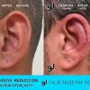 Reduccion del tamaño de las Orejas - Joaquim Suñol