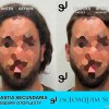 Otoplastia de orejas prominentes o separadas - Joaquim Suñol
