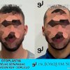 Otoplastia de orejas prominentes o separadas - Joaquim Suñol